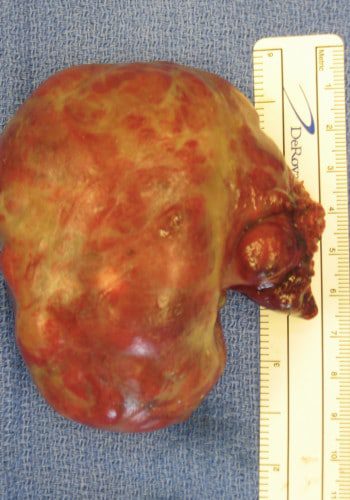 After Image: Craniofacial Tumor (Teratoma) - front