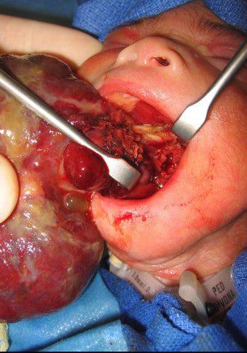 Before Image: Craniofacial Tumor (Teratoma) - front