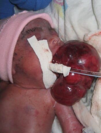 After Image: Craniofacial Tumor (Teratoma) - front