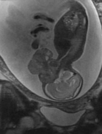 Before Image: Craniofacial Tumor (Teratoma) - front