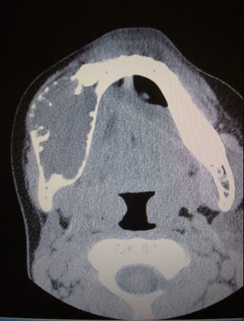 Before Image: Craniofacial Tumor - front