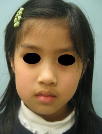 Before Image: Craniofacial Tumor - other