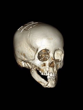 After Image: Craniofacial Tumor - front
