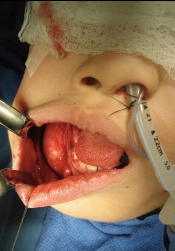 Before Image: Craniofacial Tumor - front