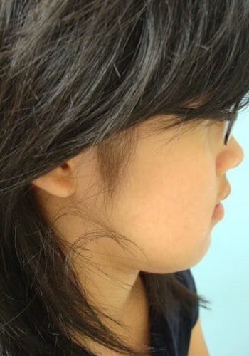 After Image: Craniofacial Tumor - front