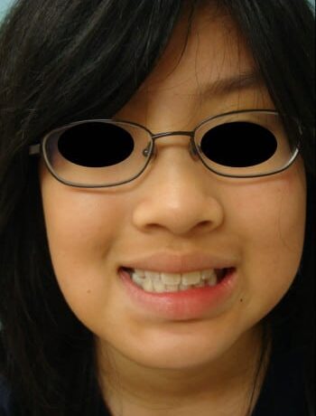 After Image: Craniofacial Tumor - other