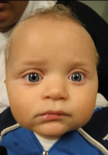 After Image: Craniosynostosis - front