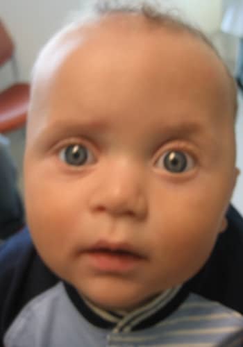 Before Image: Craniosynostosis - front