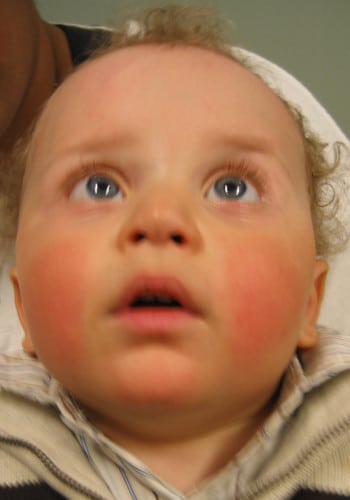 After Image: Craniosynostosis - front