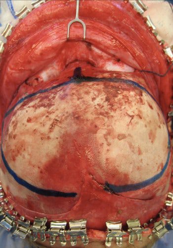 Before Image: Craniosynostosis - front