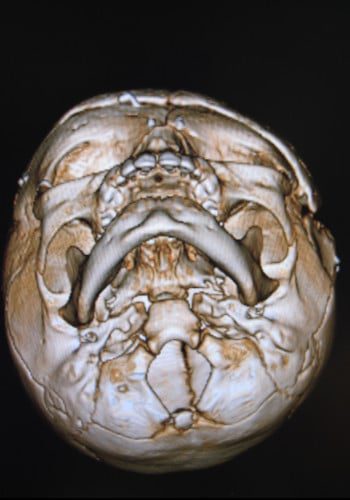 After Image: Craniosynostosis - front