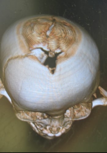 Before Image: Craniosynostosis - front