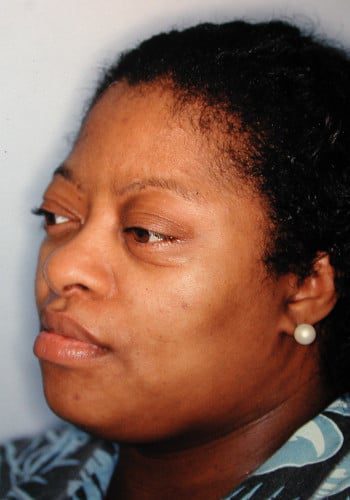 After Image: Craniofacial Tumor - left-front-oblique
