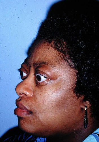 Before Image: Craniofacial Tumor - left-front-oblique