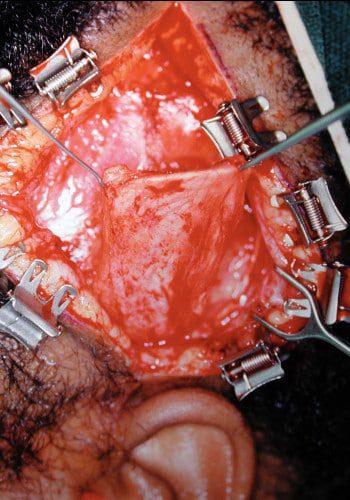After Image: Craniofacial Tumor - front