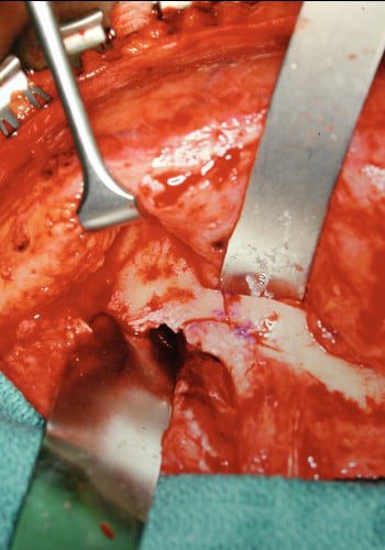 Before Image: Craniofacial Tumor - front