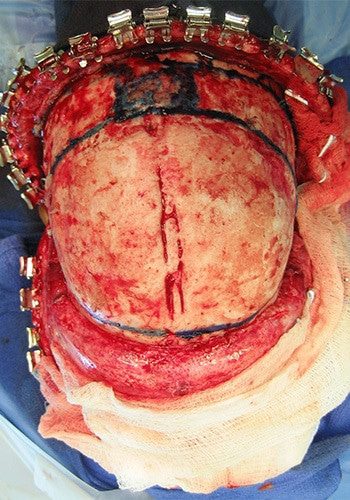 After Image: Craniosynostosis - front