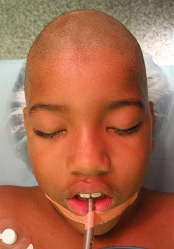 Before Image: Craniosynostosis - front
