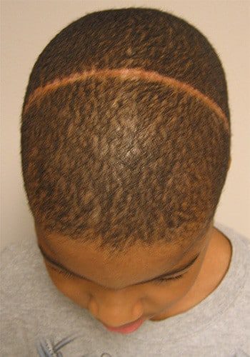 After Image: Craniosynostosis - front