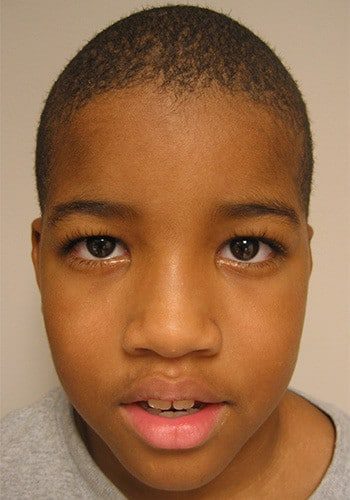Before Image: Craniosynostosis - front