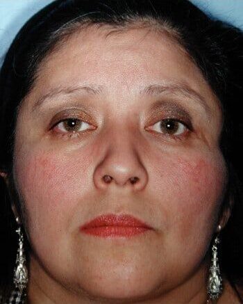 After Image: Craniofacial Tumor - front