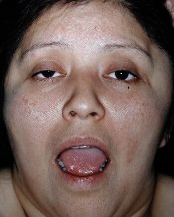 Before Image: Craniofacial Tumor - front