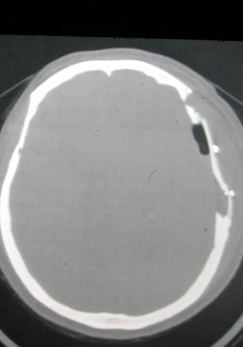 After Image: Craniofacial Tumor - front