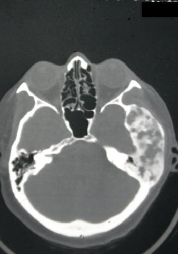 Before Image: Craniofacial Tumor - front