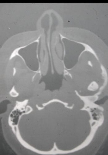 After Image: Craniofacial Tumor - front