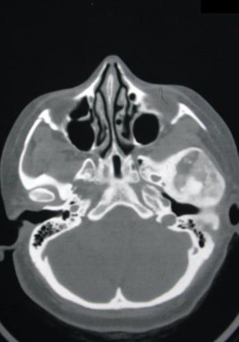 Before Image: Craniofacial Tumor - front