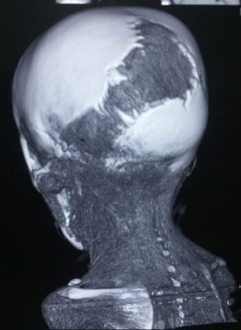 After Image: Neurofibromatosis Case Study 11 – Facial Case Insight - left-side