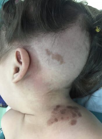 Before Image: Neurofibromatosis Case Study 11 – Facial Case Insight - left-side