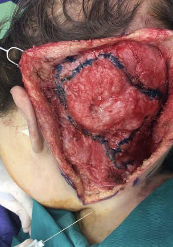 After Image: Neurofibromatosis Case Study 11 – Facial Case Insight - back