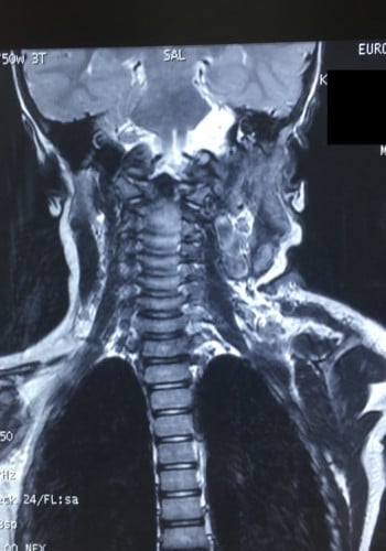 Before Image: Neurofibromatosis Case Study 11 – Facial Case Insight - back