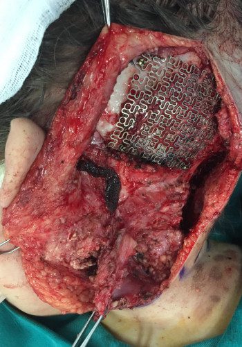 After Image: Neurofibromatosis Case Study 11 – Facial Case Insight - front