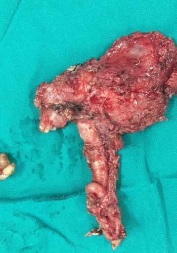 Before Image: Neurofibromatosis Case Study 11 – Facial Case Insight - front