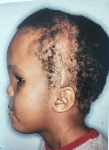 After Image: Craniosynostosis - left-side