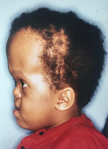 Before Image: Craniosynostosis - left-side