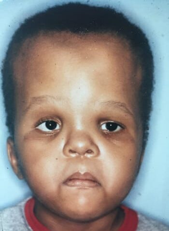 After Image: Craniosynostosis - front