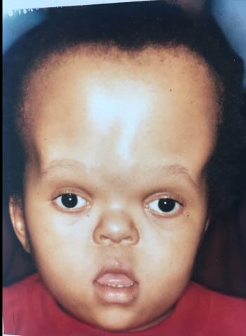 Before Image: Craniosynostosis - front