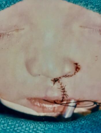 After Image: Cleft Lip - front