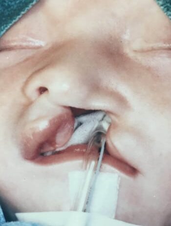 Before Image: Cleft Lip - front
