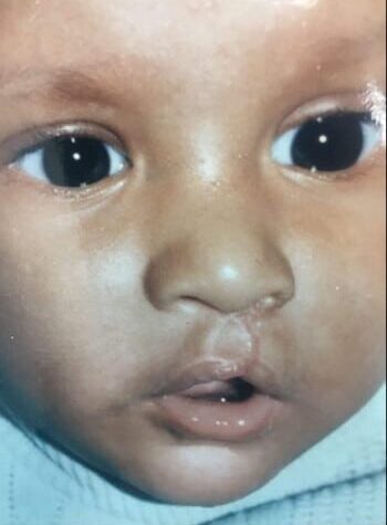 After Image: Cleft Lip - front
