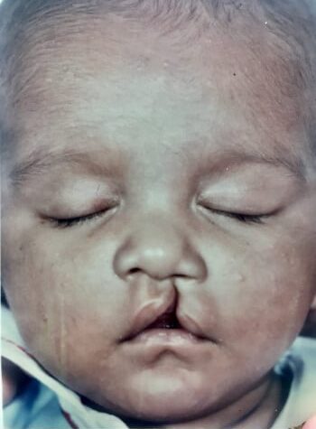 Before Image: Cleft Lip - front