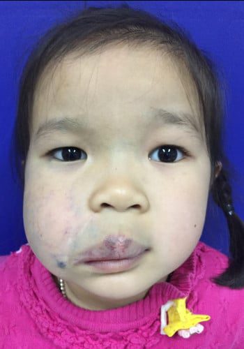 After Image: Venous Malformation - front