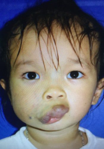 Before Image: Venous Malformation - front