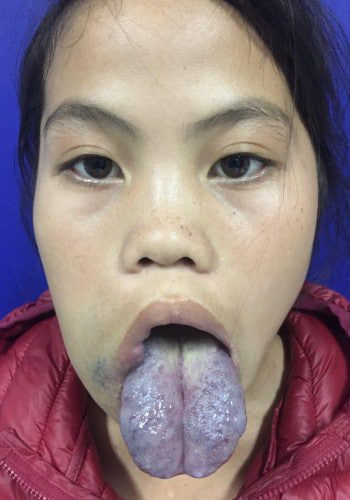 Before Image: Venous Malformation - front