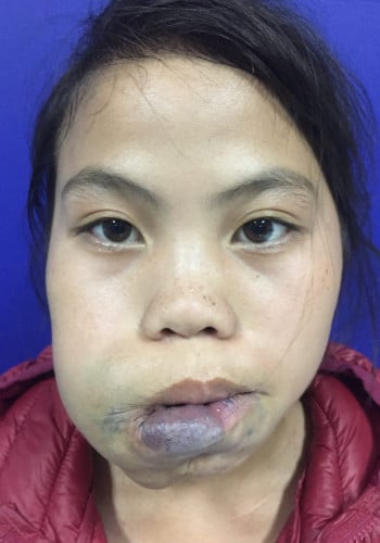 Before Image: Venous Malformation - front
