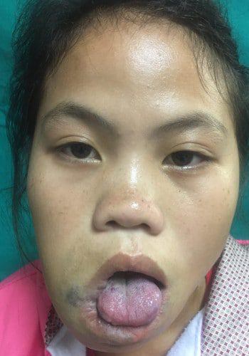 After Image: Venous Malformation - front