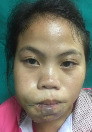 After Image: Venous Malformation - front